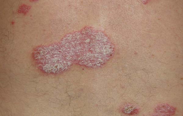 Pictures of Psoriasis Psoriasis expert