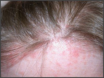 Psoriasis on forehead pictures | Psoriasis expert