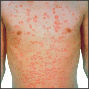 Guttate psoriasis pictures | Psoriasis expert