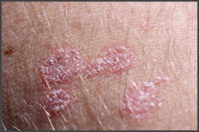 Psoriasis groin pictures | Psoriasis expert