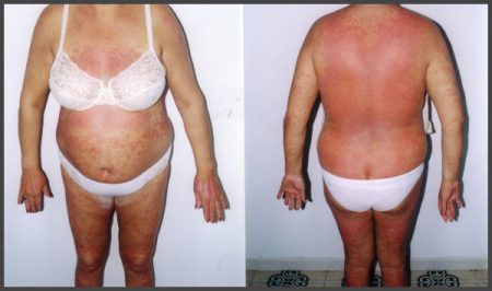 psoriasis pictures on body
