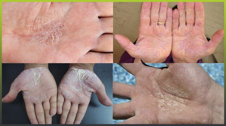 Psoriasis On The Hands And Palms Psoriasis Expert 