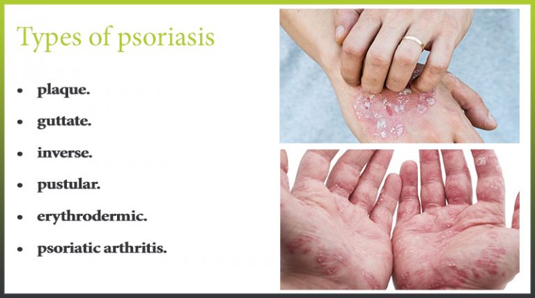 Psoriasis On The Hands And Palms Psoriasis Expert 